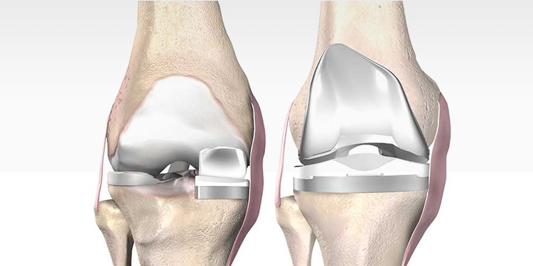 Unicondylar Knee Replacement – Marrow Clinic & Bone Care Byrathi ...